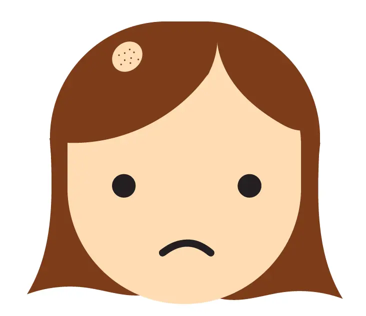 Circular bald patches are typical for alopecia areata.