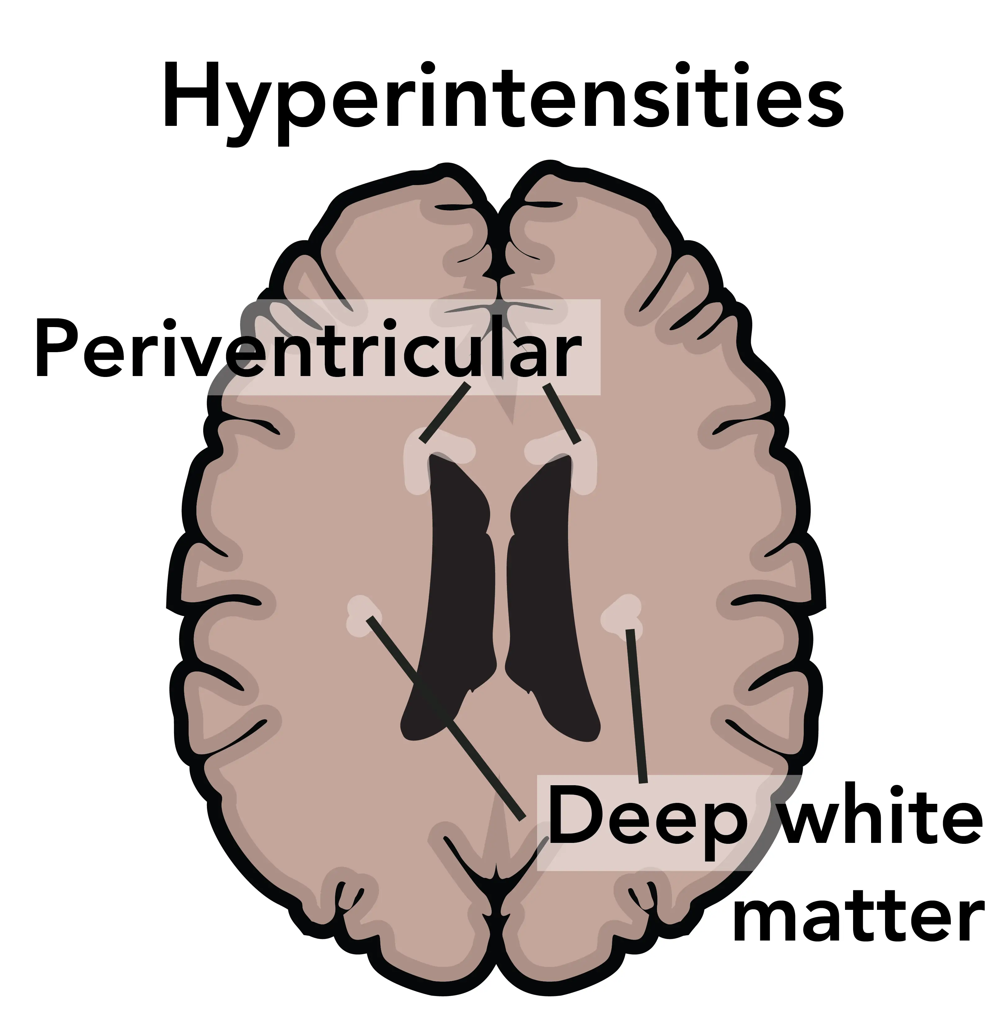 Small brain lesions do not necessarily cause immediate symptoms.