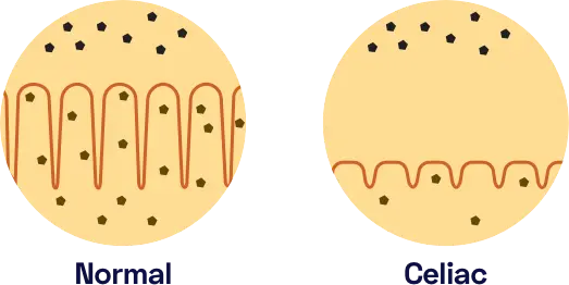 Destruction of the lining of the small intestines leads to malabsorption of nutrients.