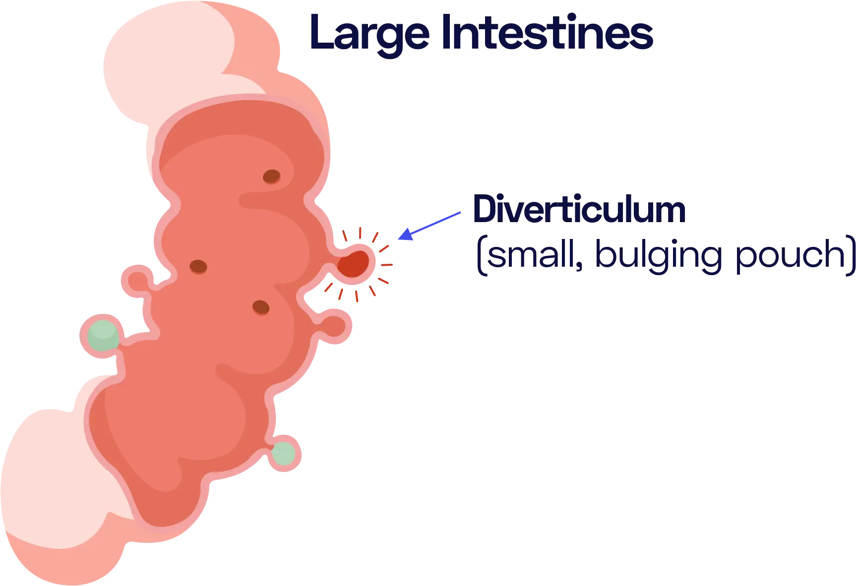 The pouches can get inflammed and cause pain.