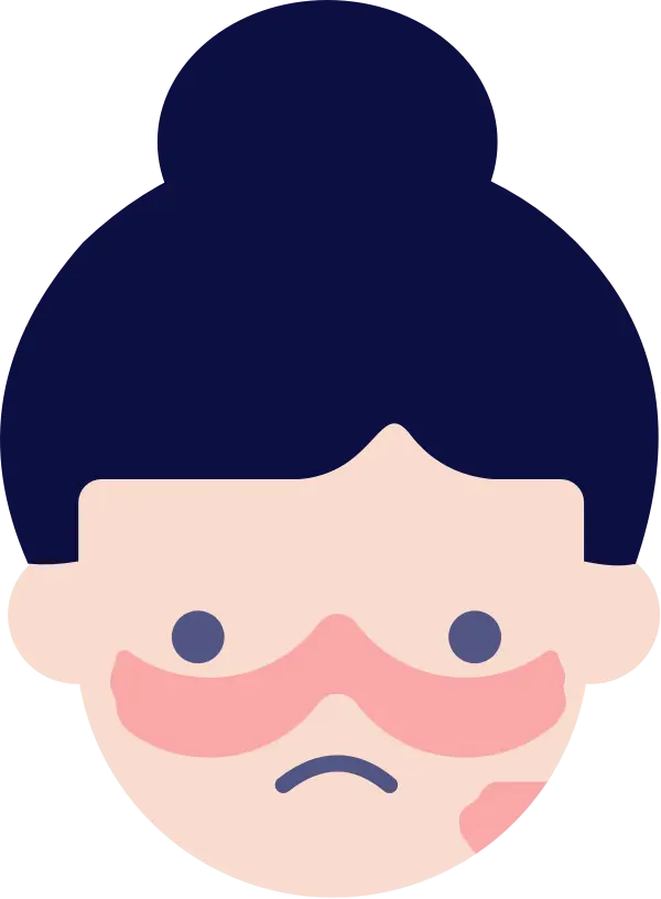 A typical sign of lupus is a butterfly-shaped rash across the cheeks and bridge of the nose.