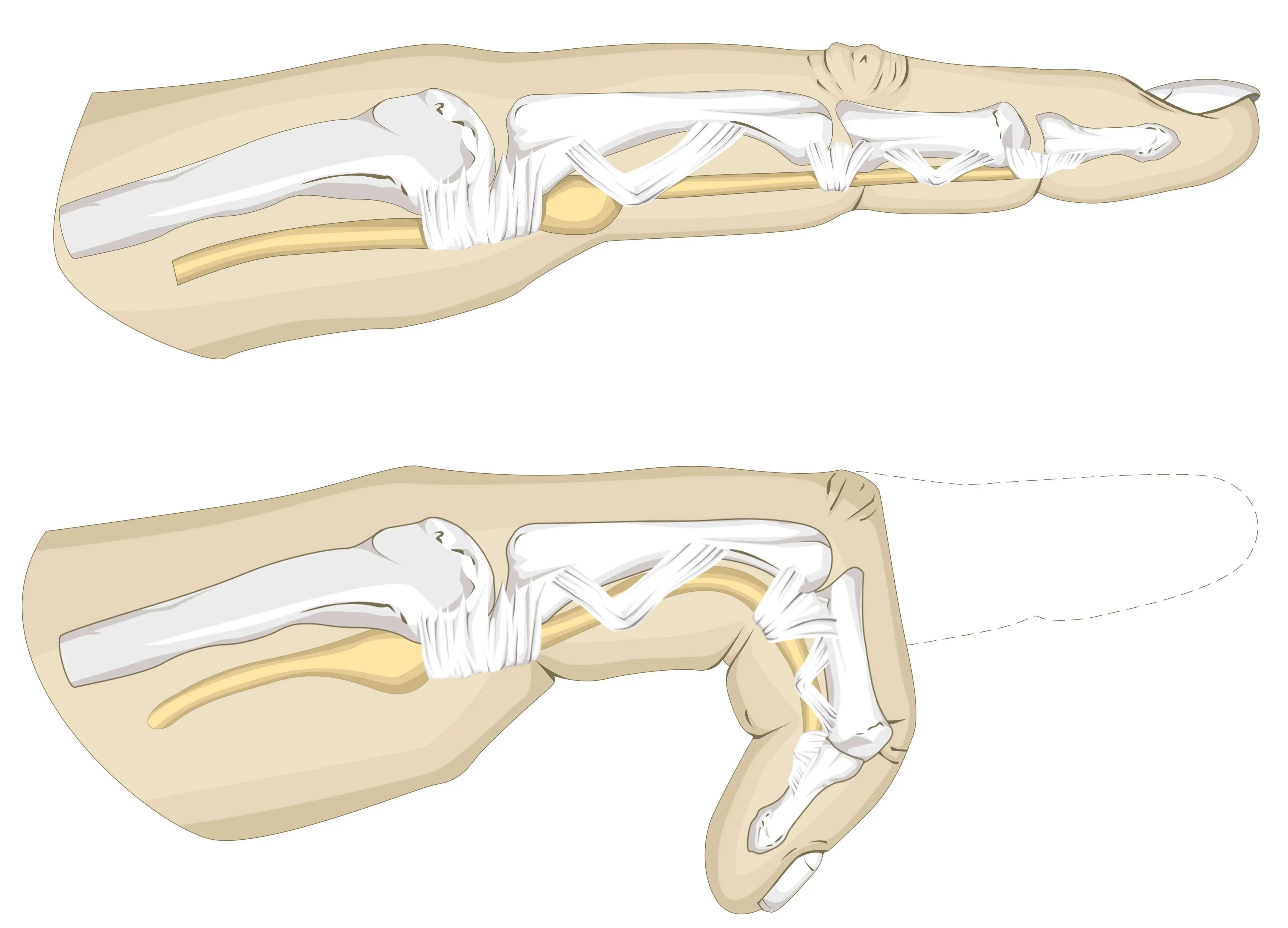 Trigger finger prevents movement.